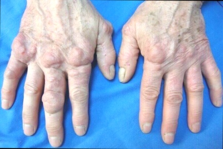 Artrobiol Plus Soulagement Douleur Hanche