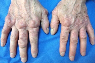 Coenzyme Q10 Arthrose