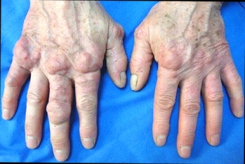 Hondro Sol Arthrose Complément Alimentaire